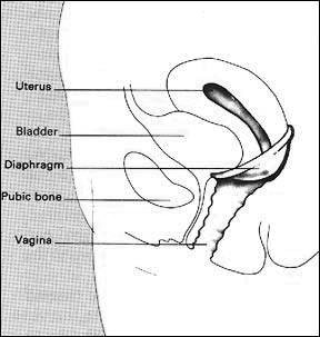 Diaphragm insertion diagram